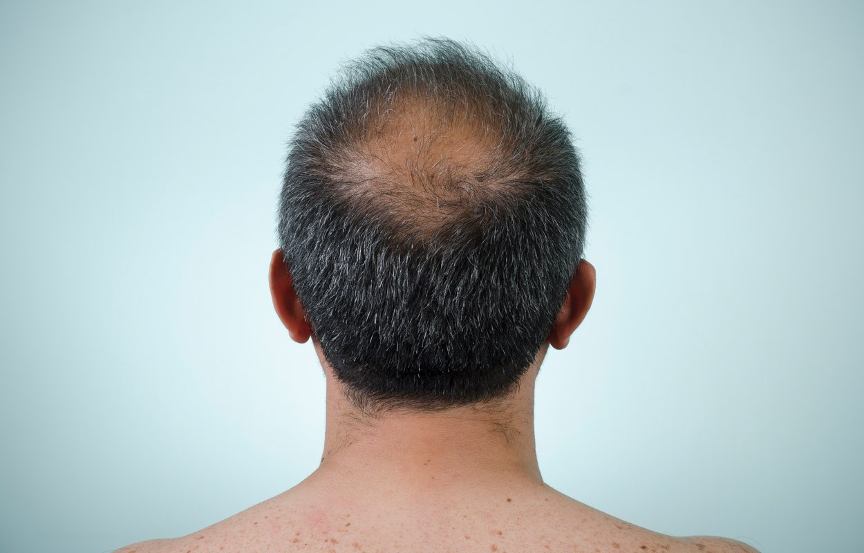 Neue Genvarianten für Haarausfall bei Männern entdeckt